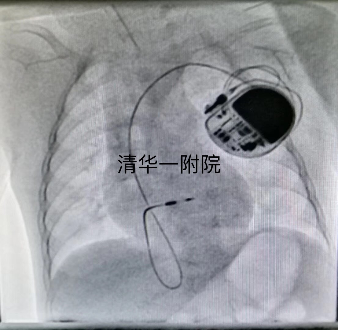 兒童起搏器那些事_心臟起搏器植入術 - 好大夫在線