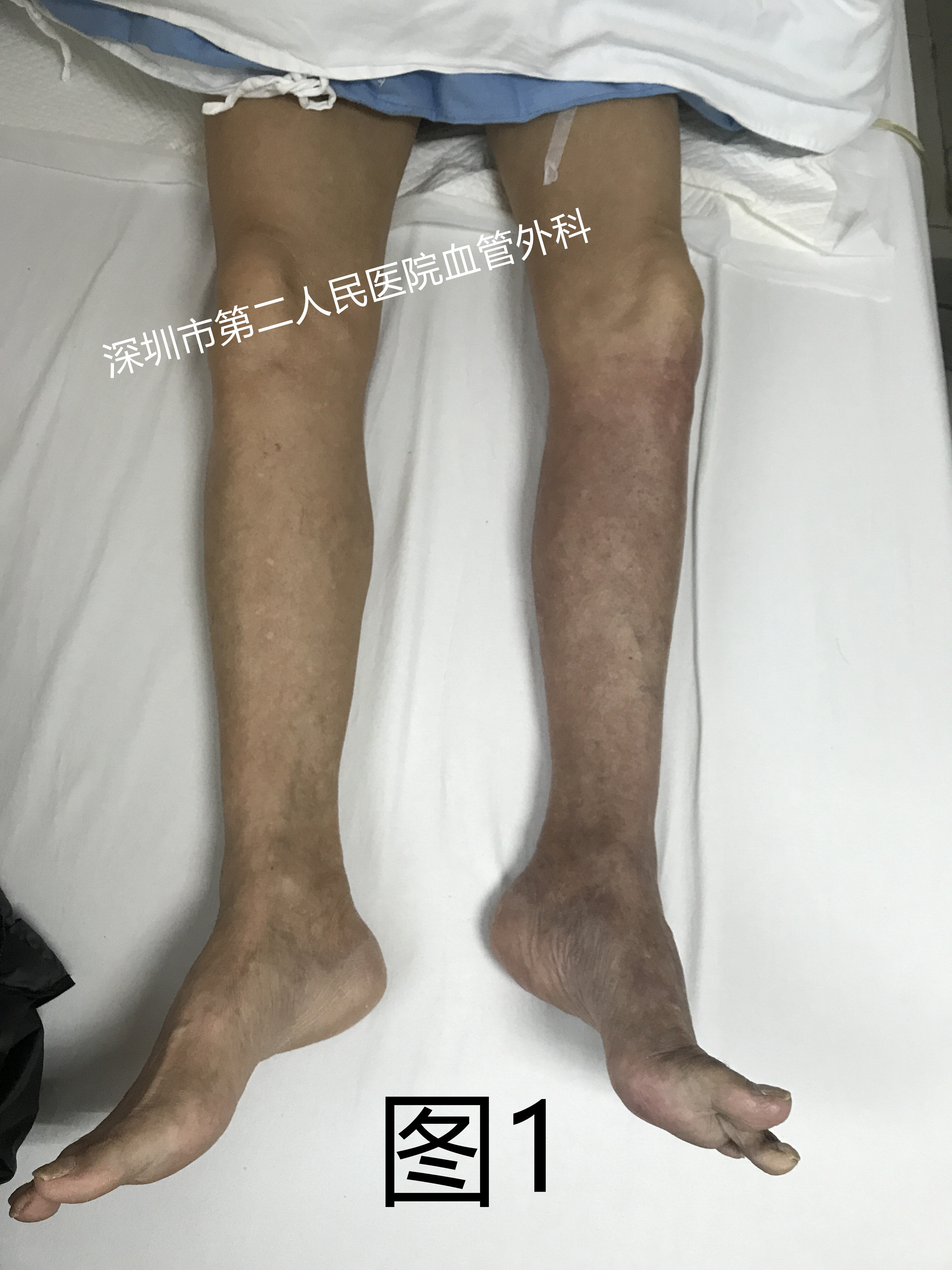 腿部疼痛 发凉 麻木 要注意这种疾病 动脉栓塞 腿部疼痛 发凉 麻木 要注意这种疾病 动脉栓塞