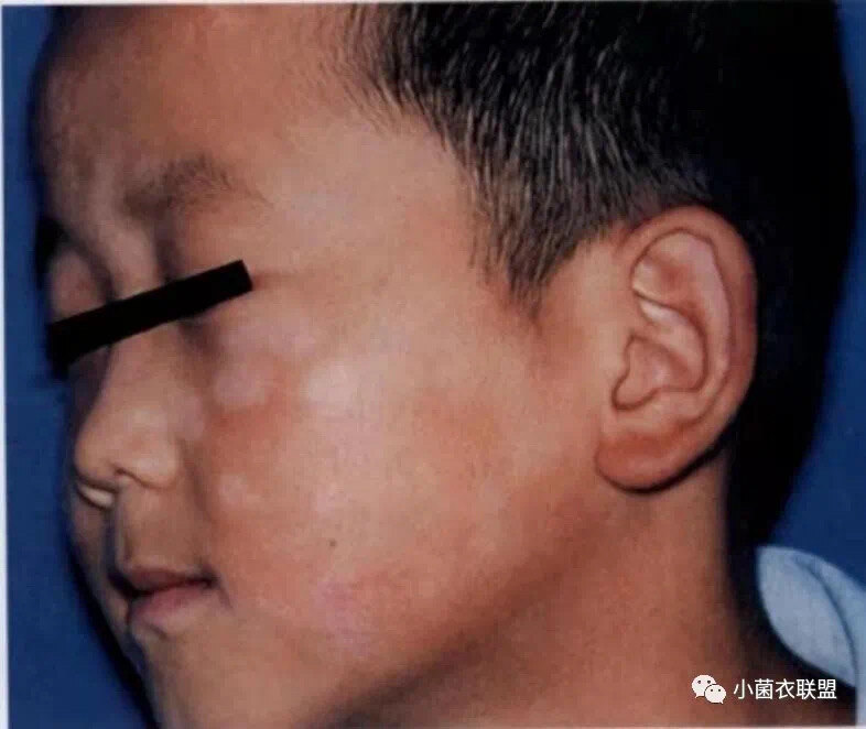 儿童斑驳病图片