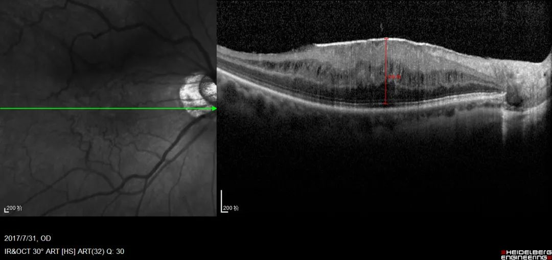 黄斑前膜_黄斑前膜治疗方式 - 好大夫在线