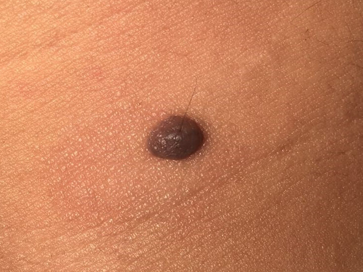 身上长鸡皮疙瘩黑点点(身上长鸡皮疙瘩黑点点图片) 身上长鸡皮疙瘩黑点点(身上长鸡皮疙瘩黑点点图片)