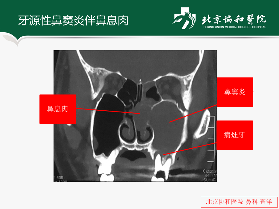 仔細觀察可以發現上頜竇下方對應的上列牙周圍可能有異常表現.c.