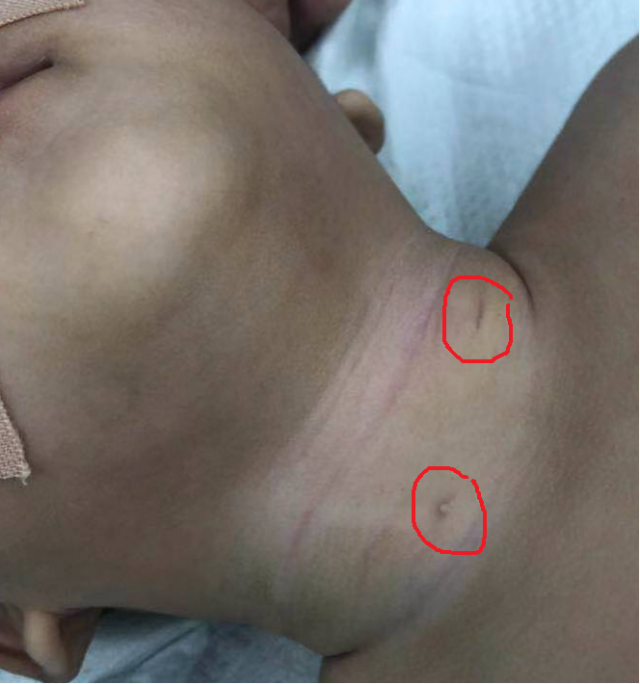 鳃裂瘘管手术疤痕图片图片