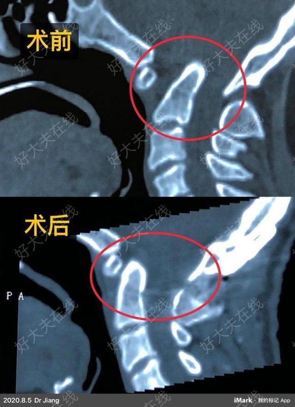 寰枕融合畸形