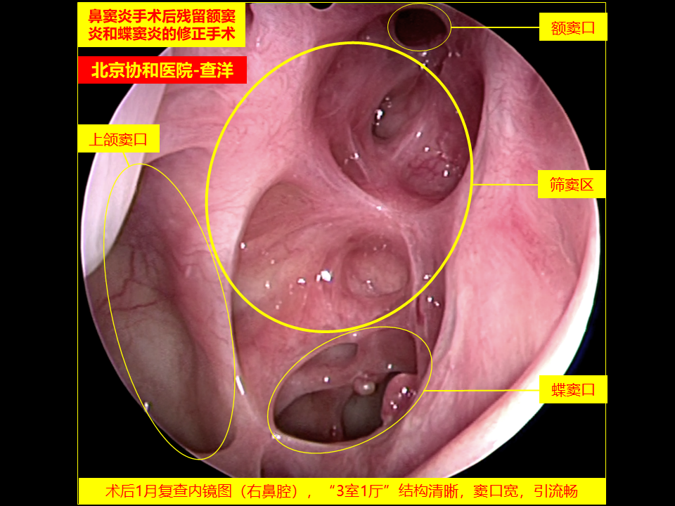 鼻窦炎 鼻息肉手术失败复发原因分析和应对处理 鼻窦炎 鼻窦炎