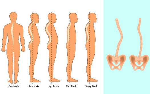 胸部不對稱,後背鼓包,骨盆傾斜等,由於比較輕度的脊柱側彎並不會導致