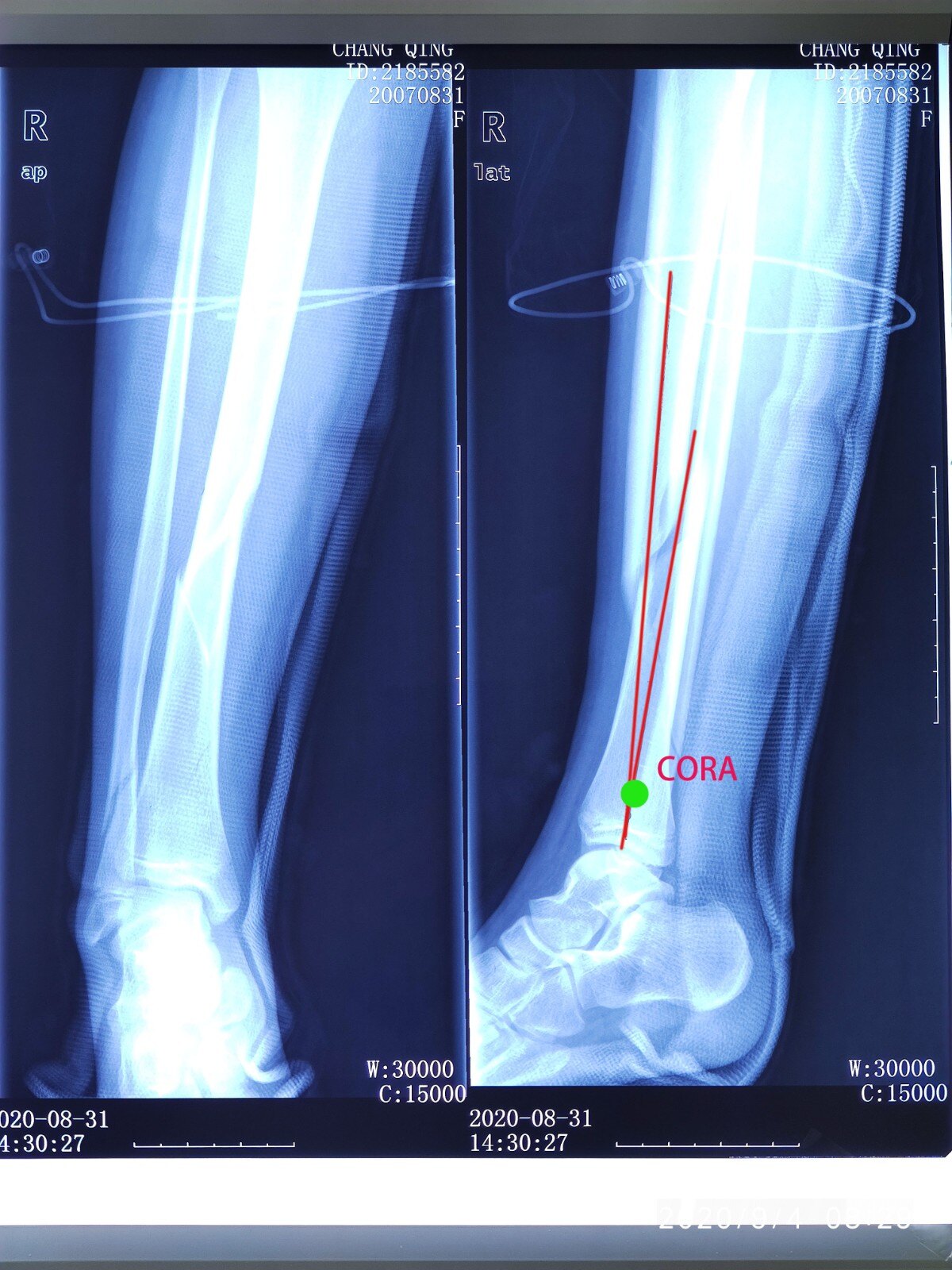 儿童胫骨骨干骨折成角畸形补救治疗 Ilizarov环形外固定技术 小儿骨折 儿童胫骨骨干骨折成角畸形补救治疗 Ilizarov环形外固定技术 小儿骨折