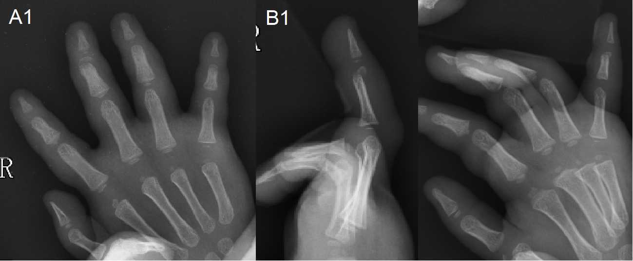 儿童指骨骨折我们也坚持闭合复位不开刀