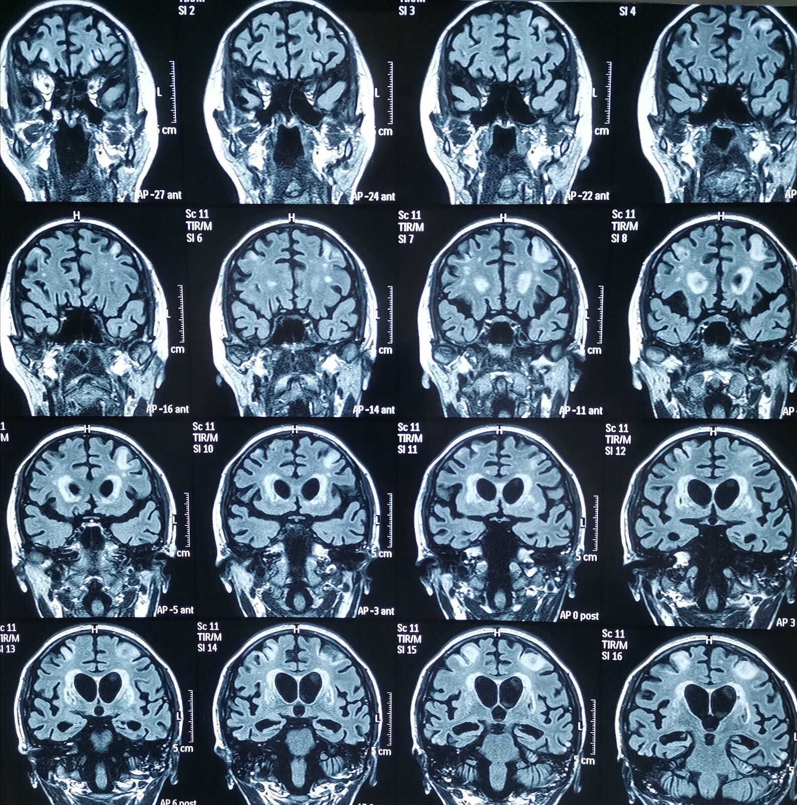 缺血缺氧性脑病的治疗放弃还是坚持