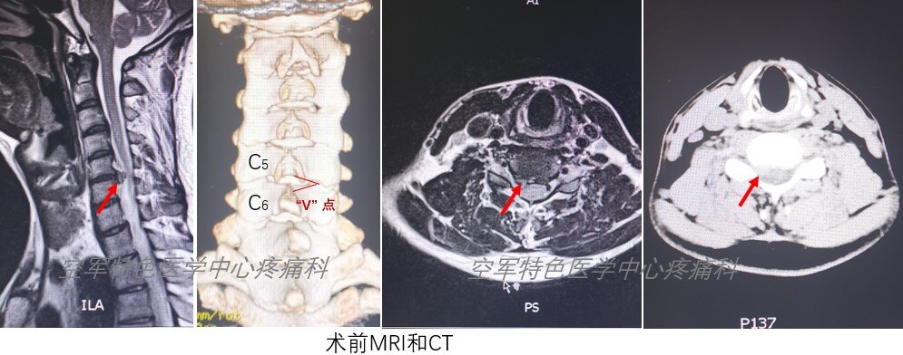 术前MRI与CT.jpg