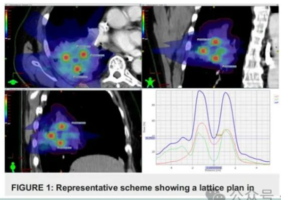 空间分割放疗（spatially fractionated radiation，SFRT）概述 - 好大夫在线