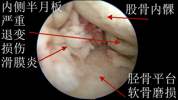 3内侧半月板严重退变损伤滑膜炎.png