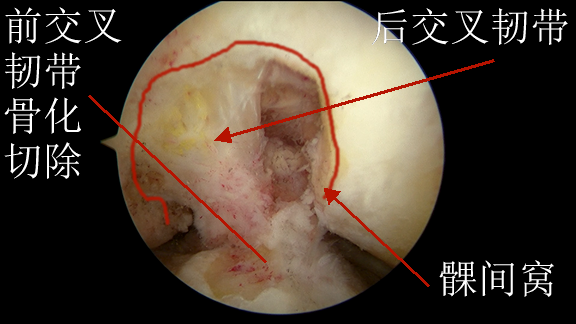 7前交叉韧带骨化切除.png