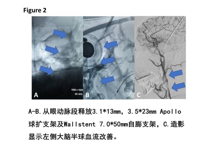 非体外循环下行cabg,lima-lad ao-svg-d1-om-pda(中远端血管广泛钙化