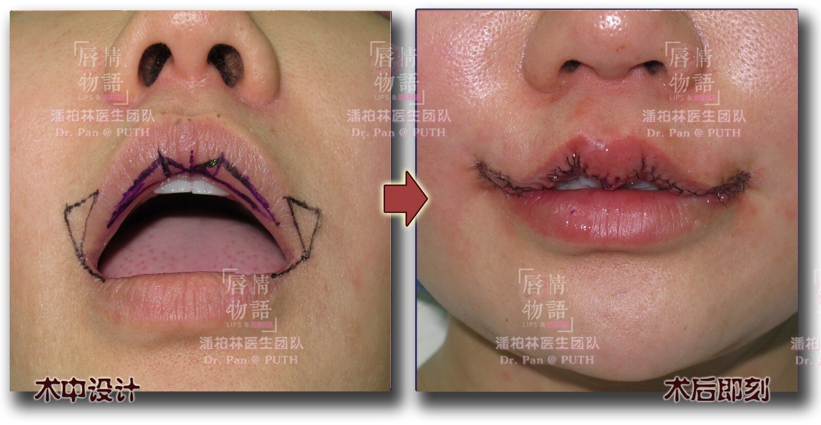 上唇綜合整形(upper lip vermilion plasty):修薄/m唇/Ω唇