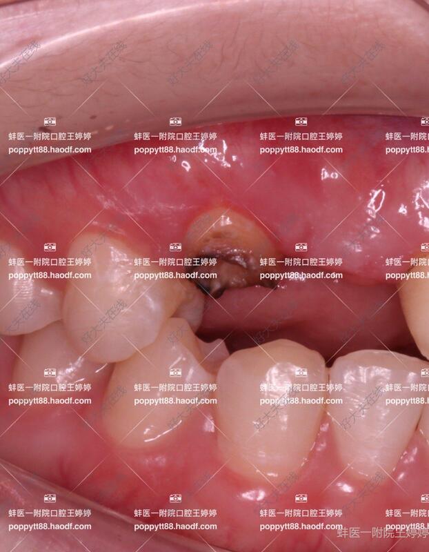 牙冠延长术