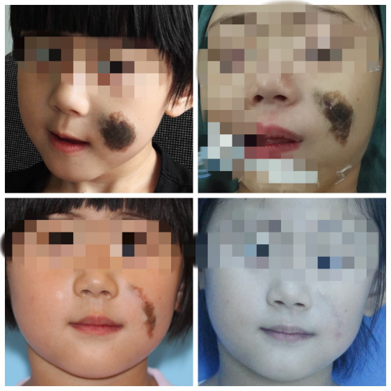 儿童黑色素痣手术过程图片