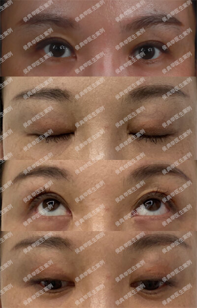 双眼皮失败的十种表现 下 双眼皮手术 双眼皮手术