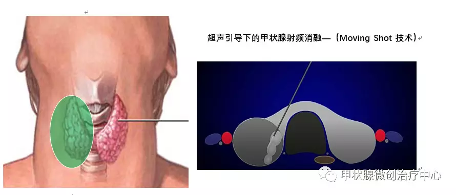 甲状腺射频消融术图片