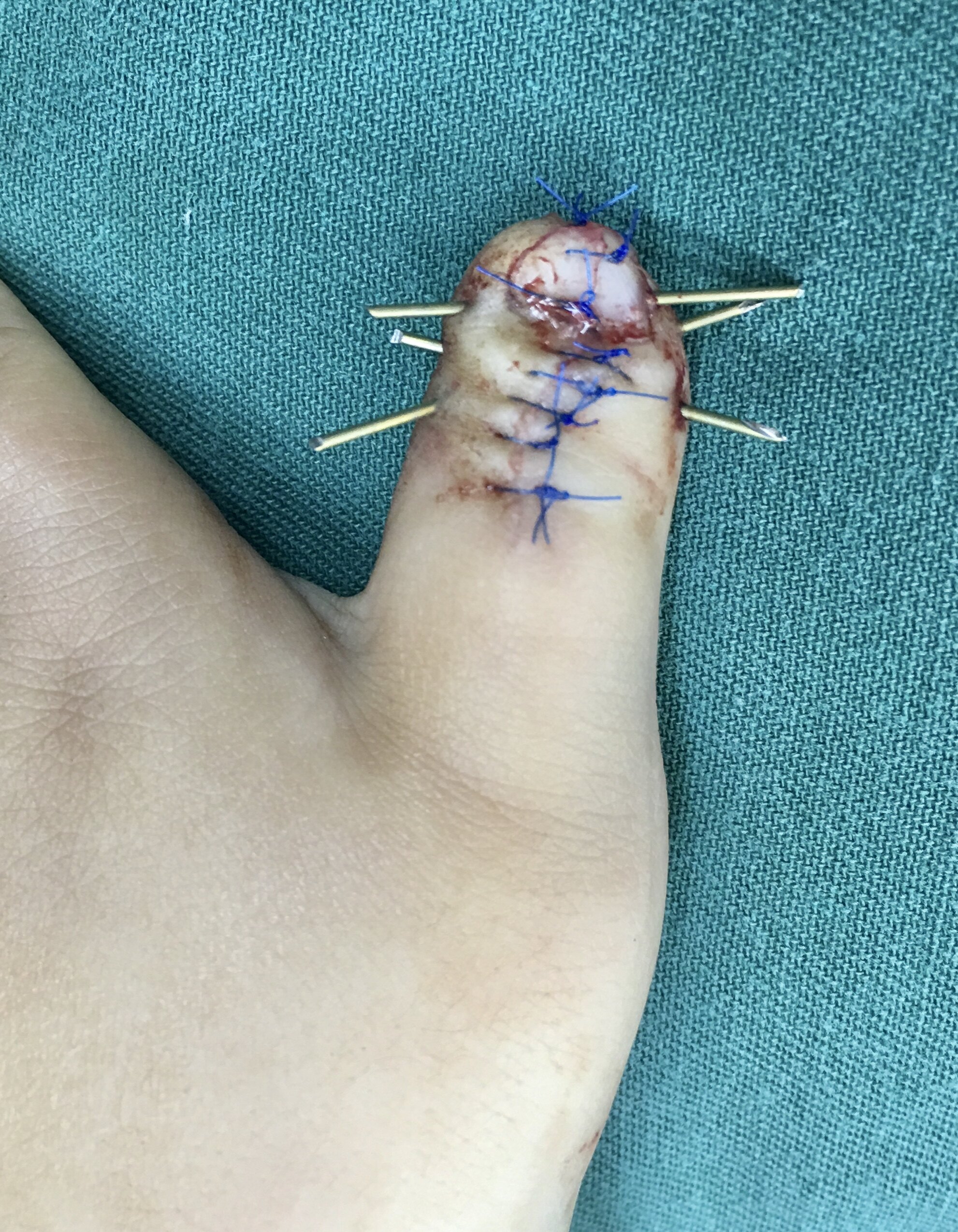 拇指多指畸形之一镜像拇—b-c手术_多指畸形_多指畸形治疗方式 - 好