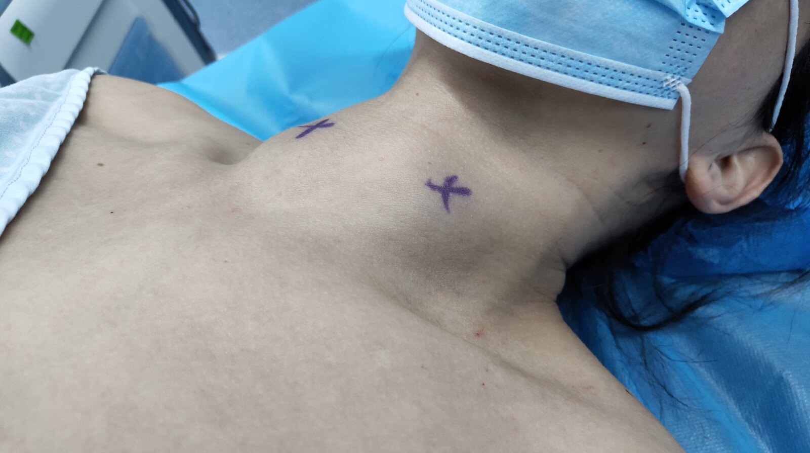 精选病例2超声引导下甲状腺多发结节射频消融术穿刺硬化术