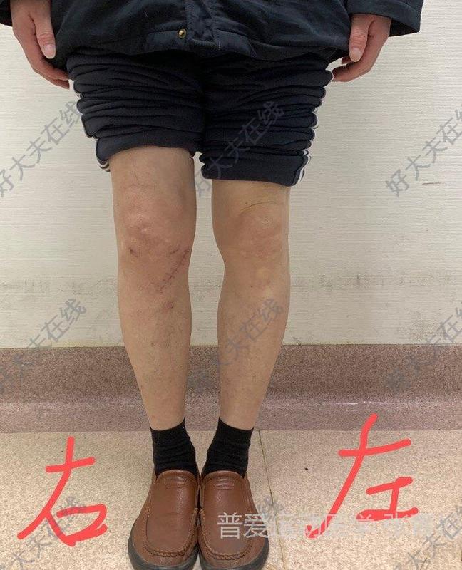 双膝内翻o型腿,膝痛_o型腿 - 好大夫在线