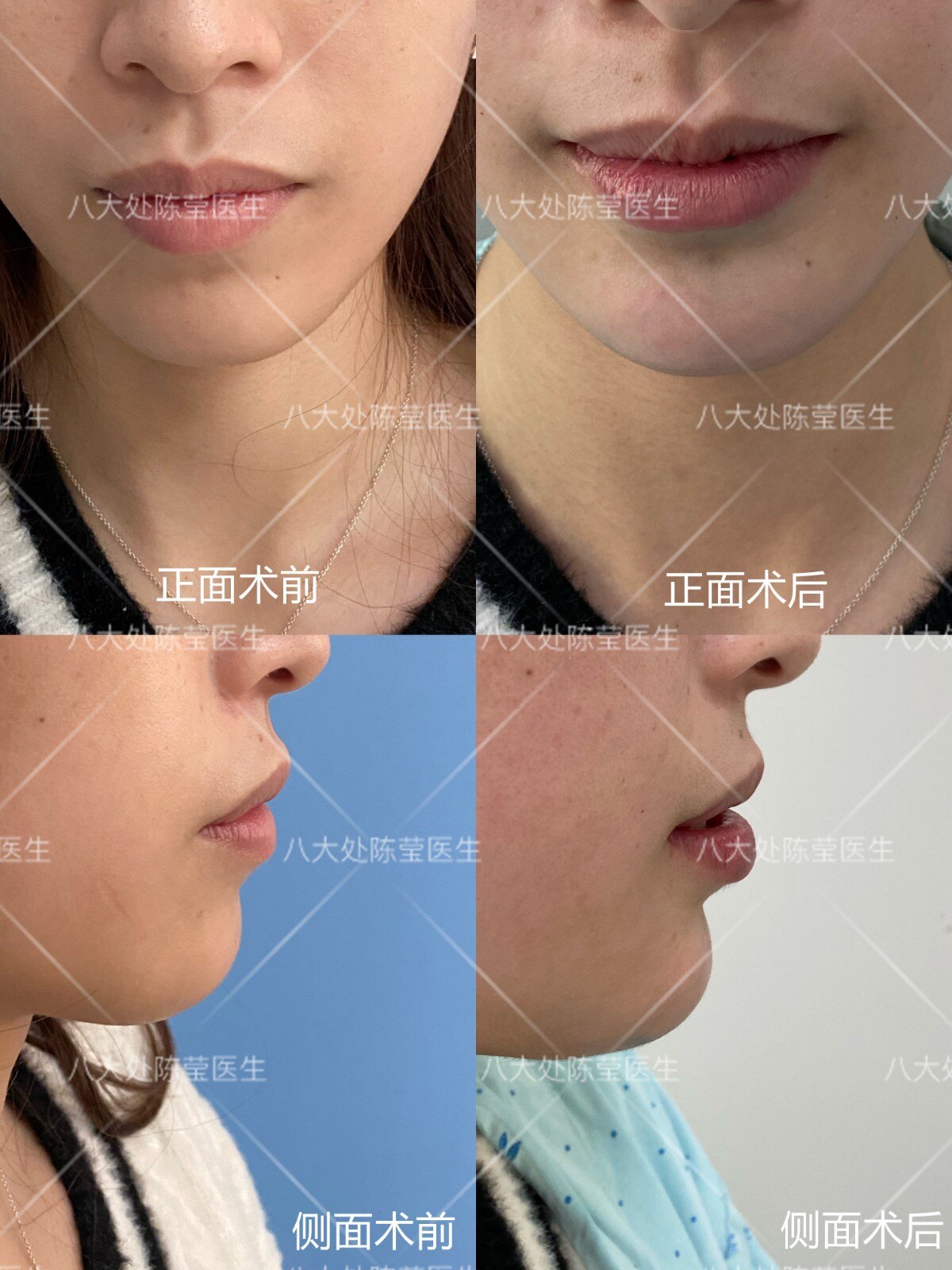案例1求美者自述:假体垫下巴后下巴出来了,翘度很自然,嘴凸也