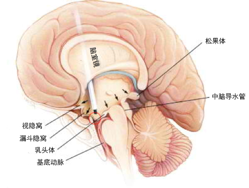 third ventriculostomy etv)就是在三脑室前部的底部用脑室镜的技术