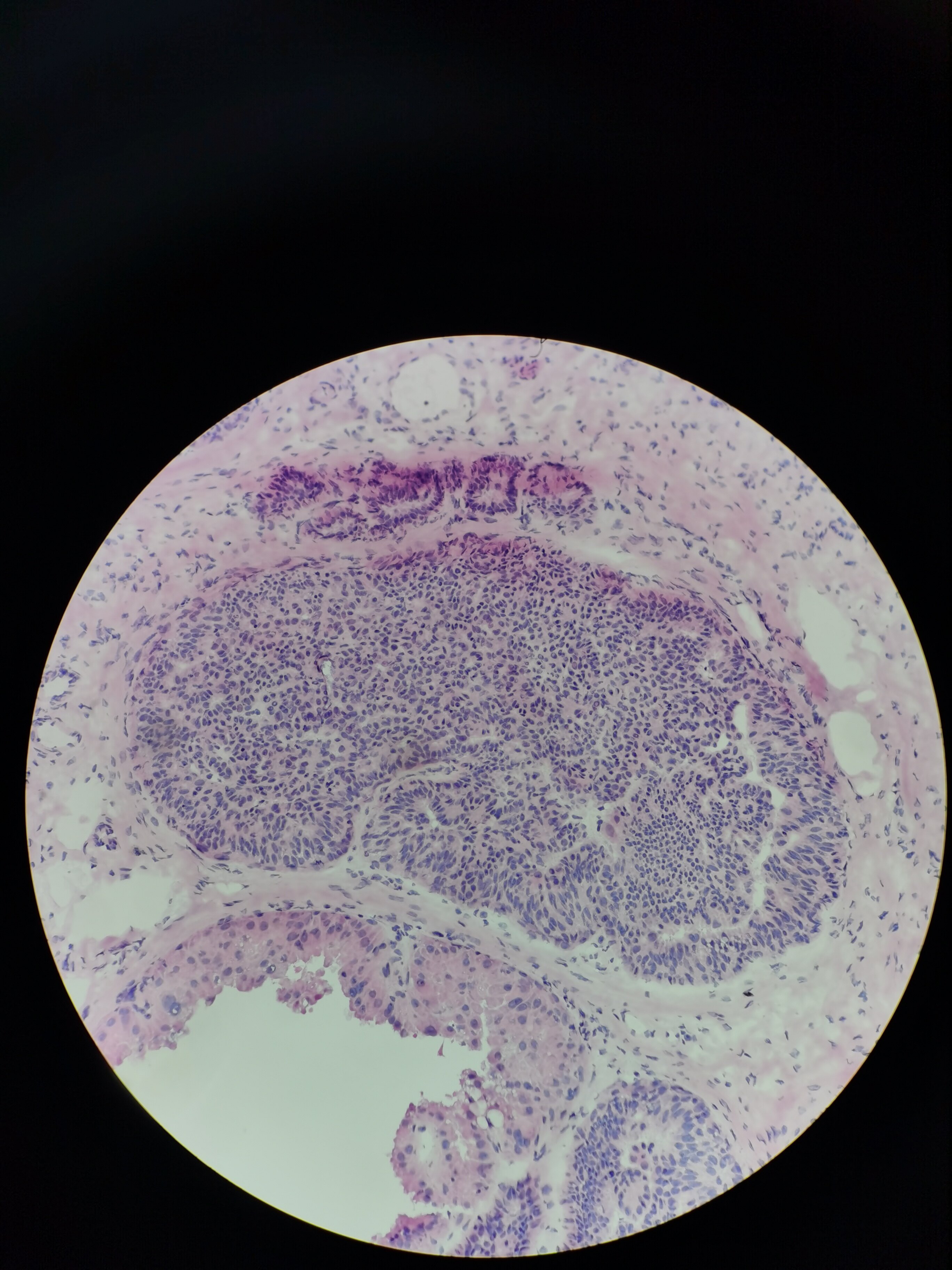 乳腺结节良恶性术中冰冻见分晓!