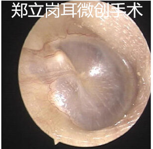 中年女性听力逐渐下降 有可能是耳硬化 耳硬化 耳硬化 中年女性听力逐渐下降 有可能是耳硬化 耳硬化 耳硬化
