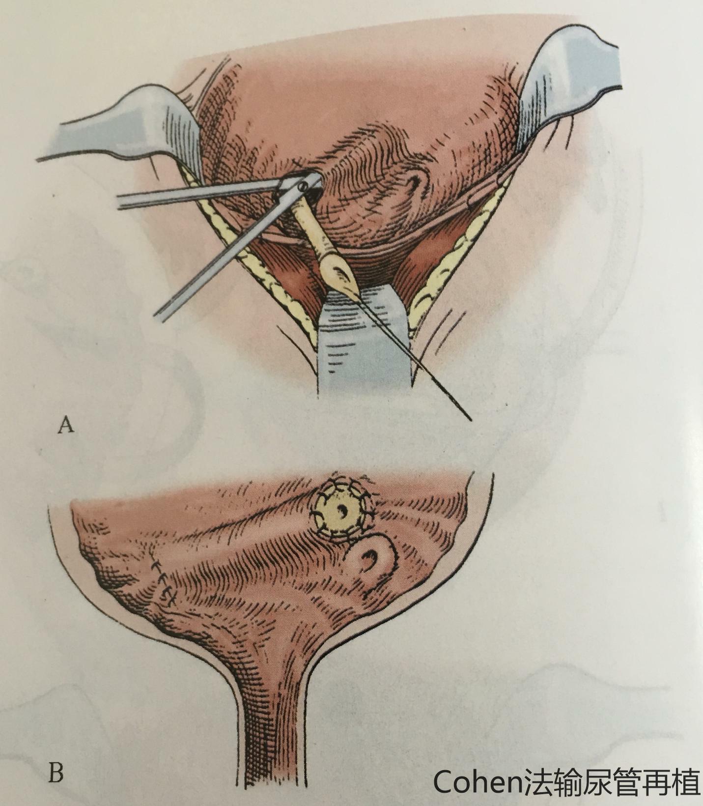 尿道插管术图片欣赏图片