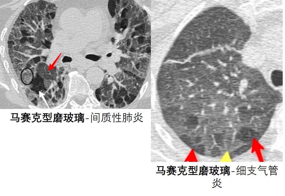 肺鳞癌是什么导致的 zoYBAGBl5iiAJ-06AAHRlSnCBL4731.jpg?_ms_=d70b
