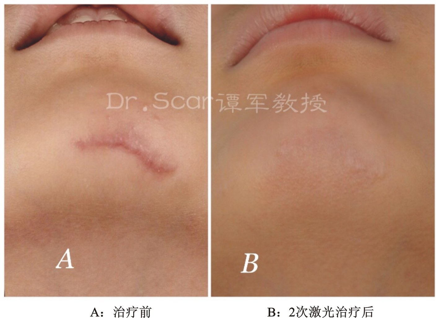 黑痣癌变图片_脚底黑痣癌变_黑痣会癌变吗