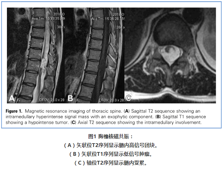 脊髓髓内"表皮样囊肿"是什么东东?如何治疗?