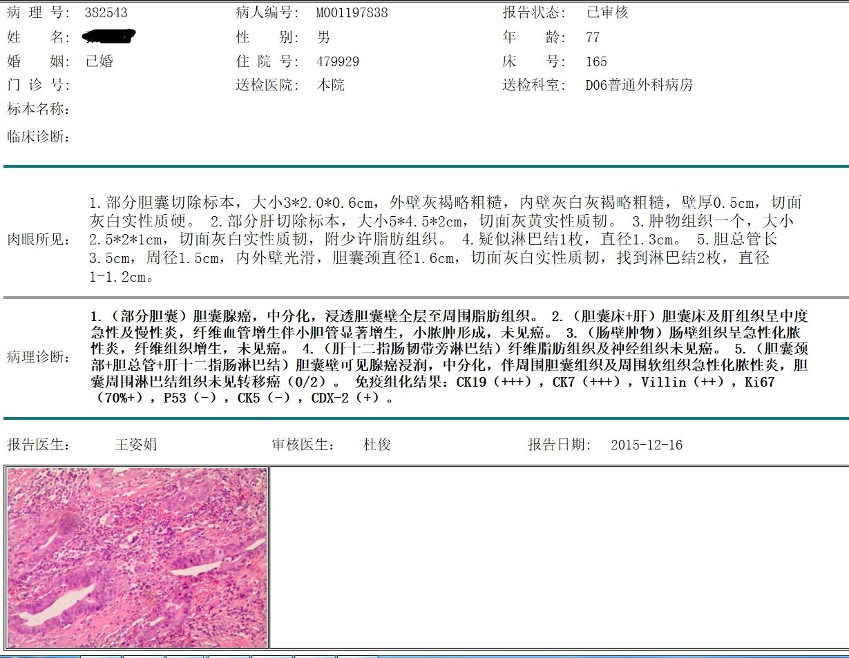 膽囊結石30年誘發膽囊癌根治手術後5年無病健康生活早發現早治療是