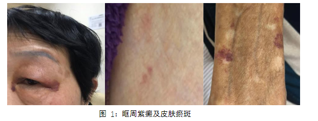 皮肤出血需警惕淀粉样变性_原发性皮肤淀粉样变_介绍_症状表现_治疗