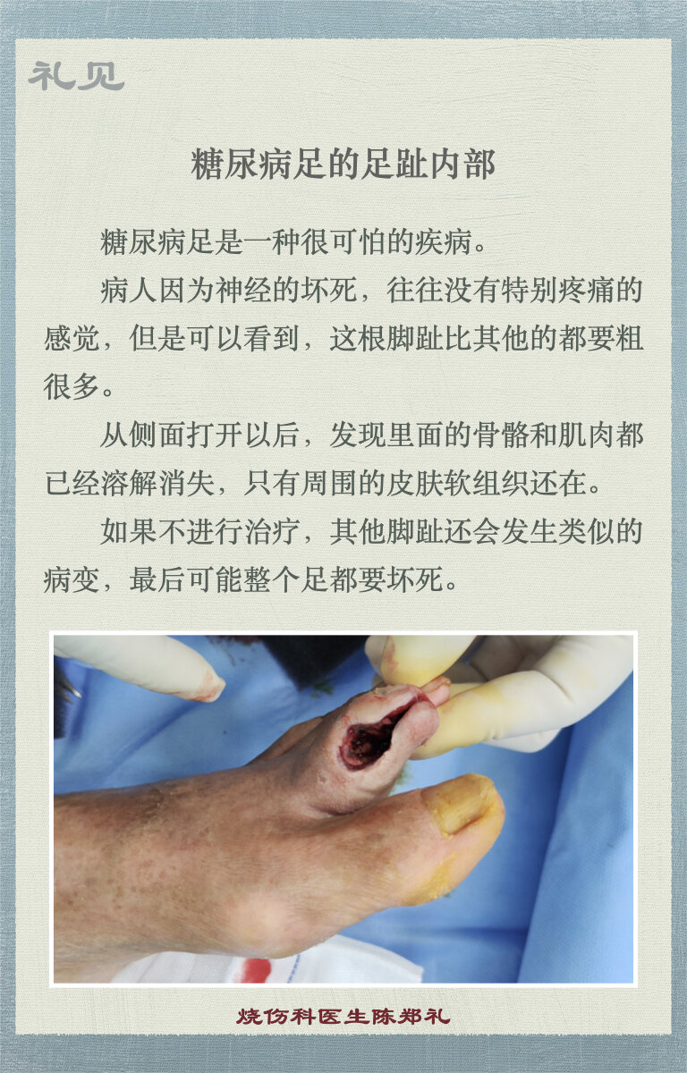 糖尿病足的足趾内部