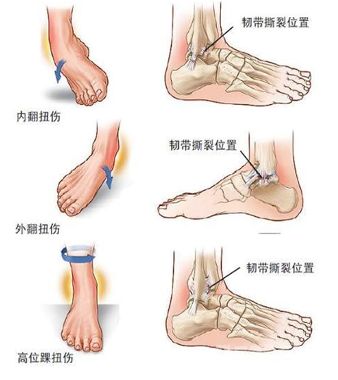踝关节扭伤后为什么经久不愈