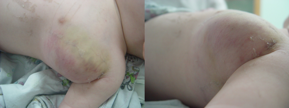 km综合征卡梅综合征卡波西血管内皮瘤治疗