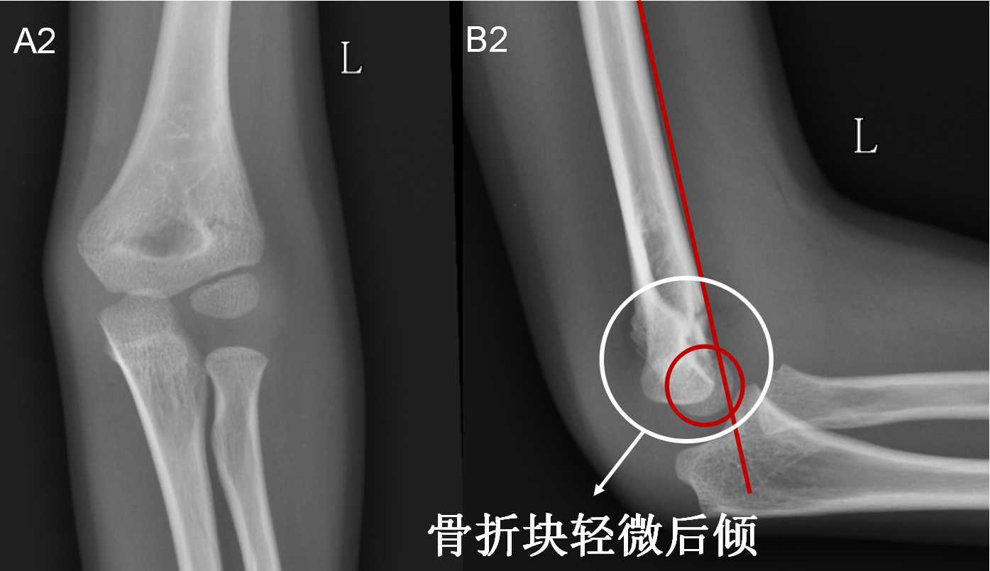一分钟让您明白肱骨髁上骨折什么时候要手术 什么时候不用手术 肱骨骨折 肱骨骨折 一分钟让您明白肱骨髁上骨折什么时候要手术 什么时候不用手术 肱骨骨折 肱骨骨折