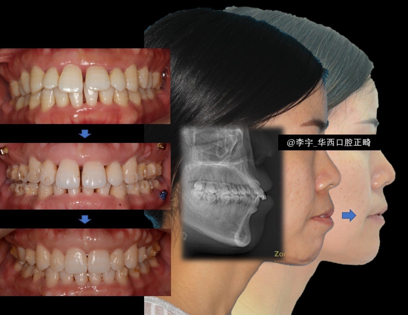 重度前突 牙槽骨非常薄 拔牙 内收,精确控根#透明矫治器