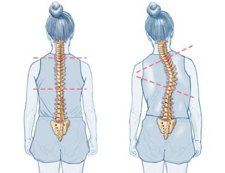 脊椎侧弯 对比图片
