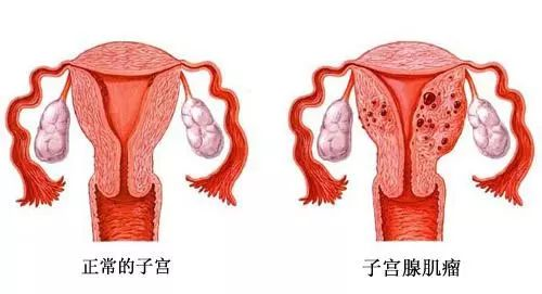 也可以理解為原發性痛經的基礎上逐漸繼發而來的.