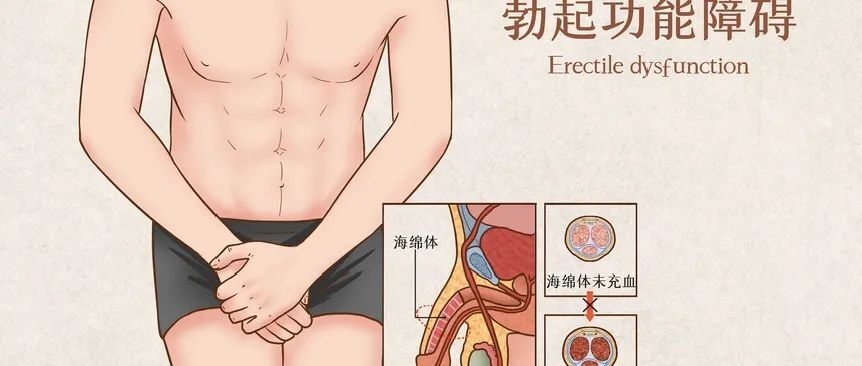 勃起障碍 勃起障碍