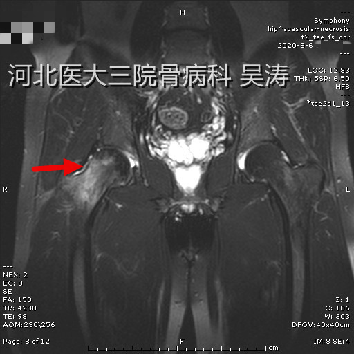 病例二 图二 2020-8-6 图片1.png