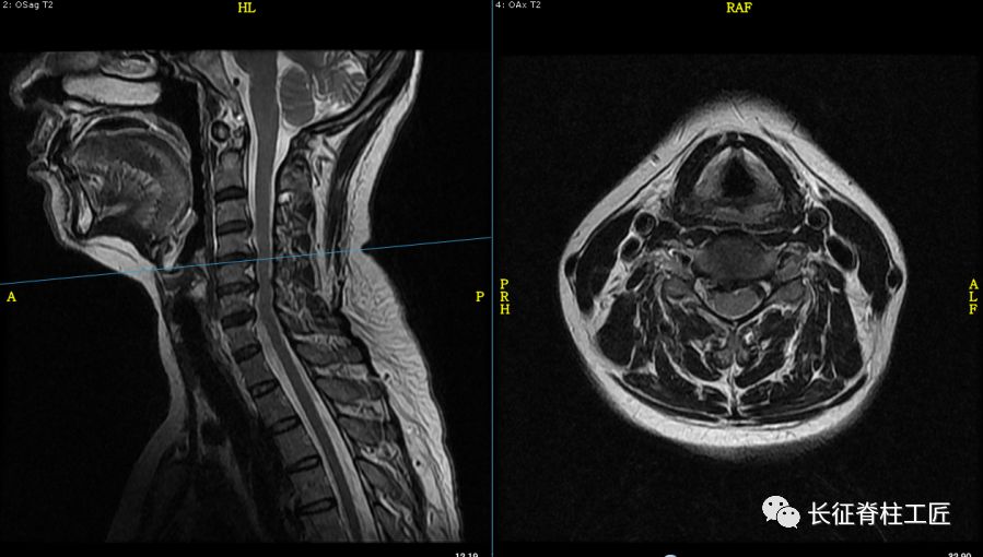 颈椎核磁图谱解析图片