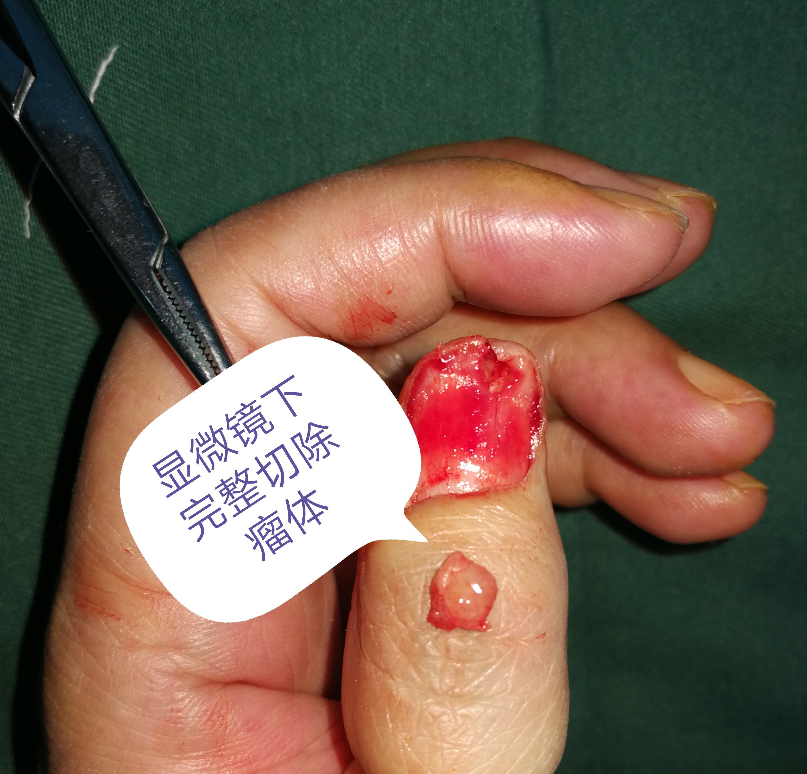 指甲黑色的素瘤图片_指甲黑色素瘤是什么颜色_指甲黑色素瘤图片