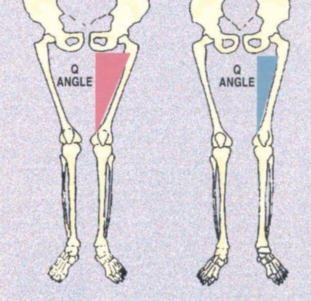 女性运动员更可能损伤acl,由于q角增大,与q角较小者相比women