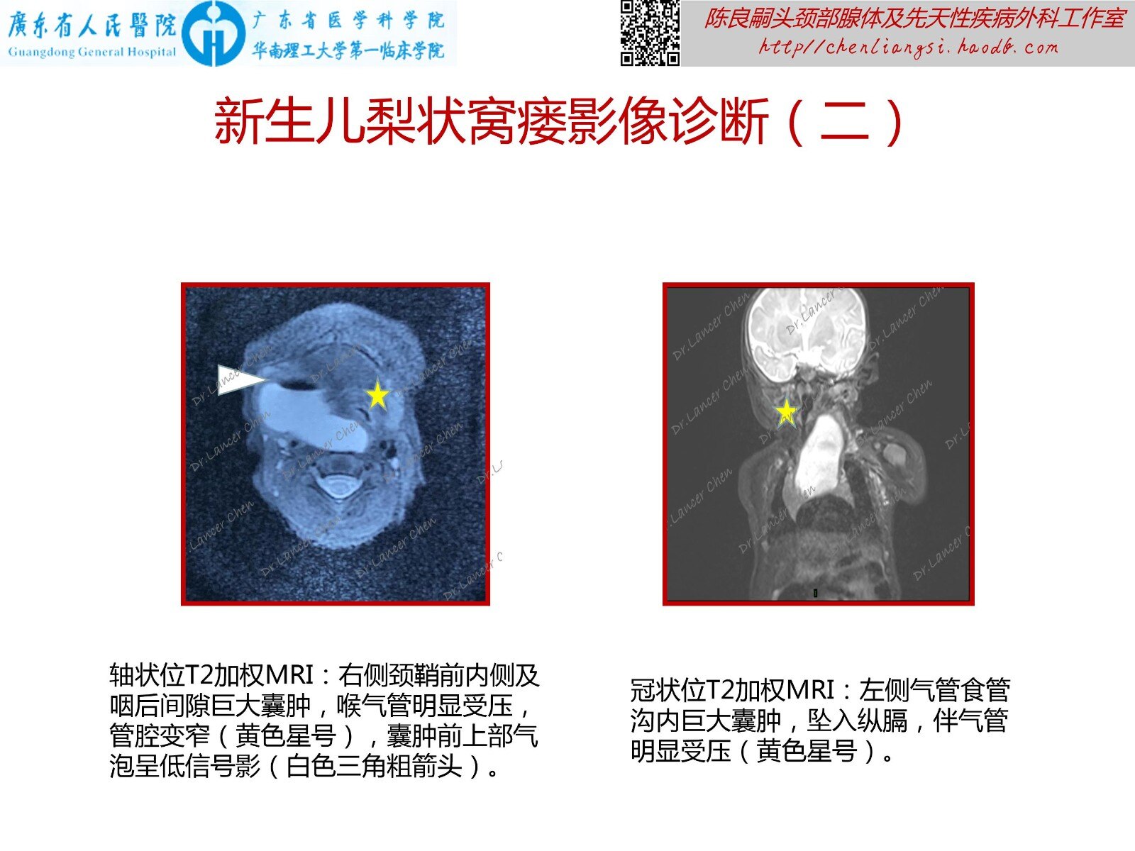 医学科普"性"相近"表"相远:新生儿梨状窝瘘,不一样的梨状窝瘘!