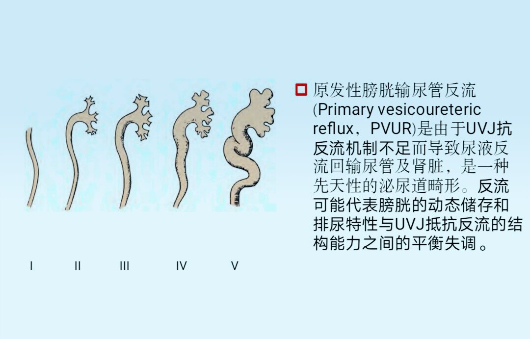 膀胱输尿管反流图片